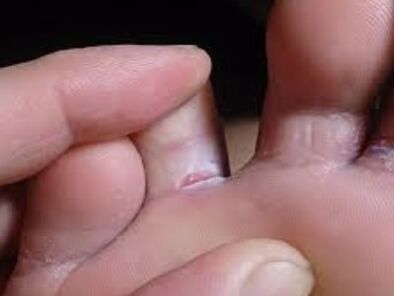 He has toe fungus