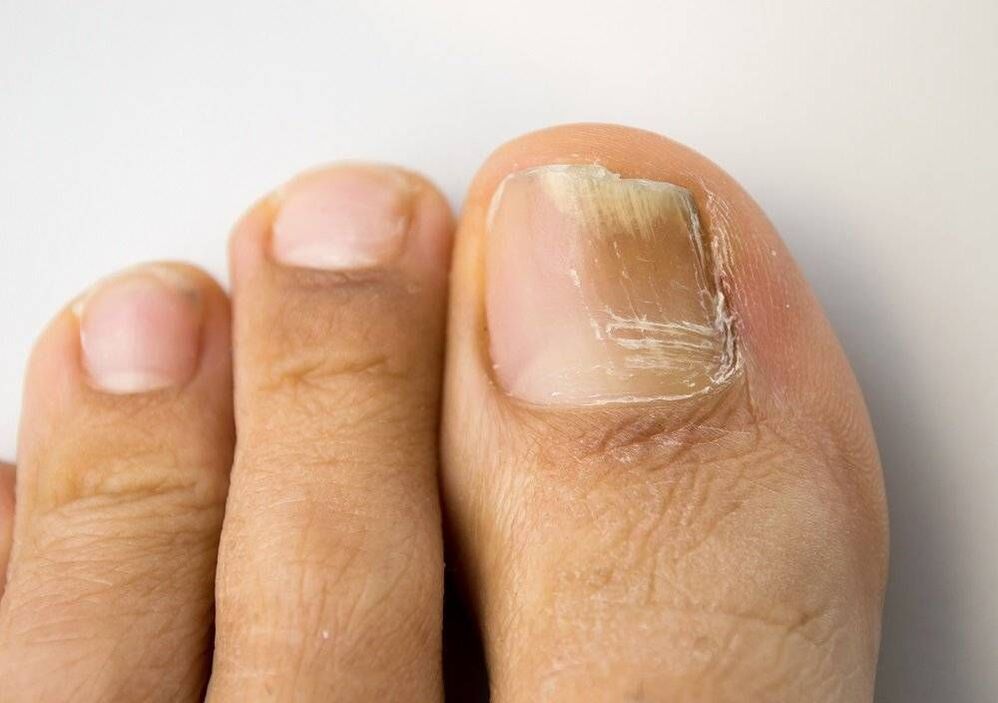 types of fungal infection on big toe