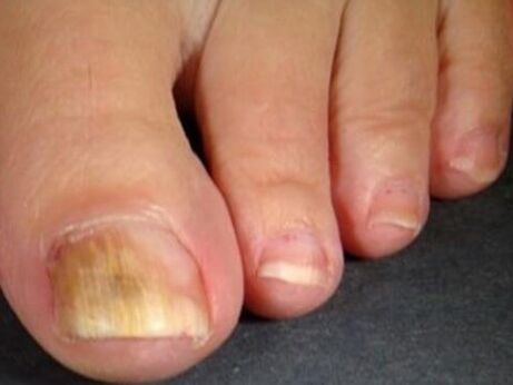 Nail fungus