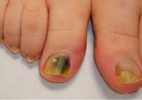 The infection affects the nail plates