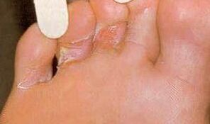 Dermaid injuries for the mycosis of the foot