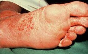 Fungus on the foot with ulcers