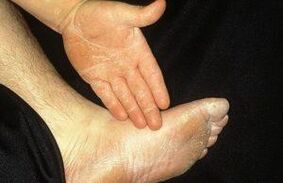 Mycosis of mycosis is manifested