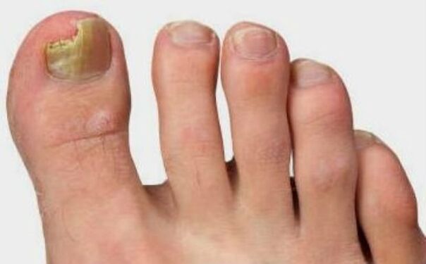 The mushroom on the thumb of the leg