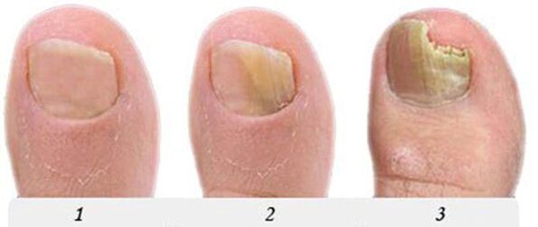 The process of development of the thumb mushroom