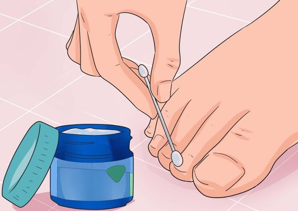 He takes care of the nail fungus