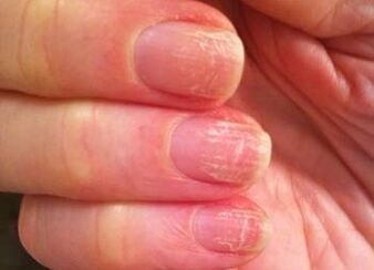 The initial phase of the mushroom on the nails