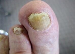 The causes of the apparition of the mushroom on the nails