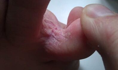 Phase of the development of the mushroom between the fingers of the feet