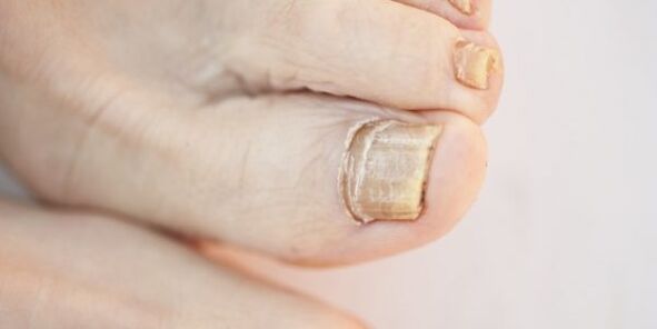 damage to toe nails due to fungus