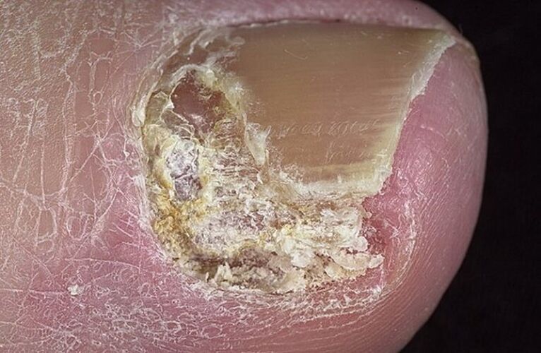 Types of onychomycosis