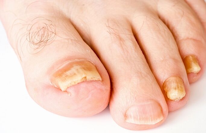 yellow nail due to a fungal infection