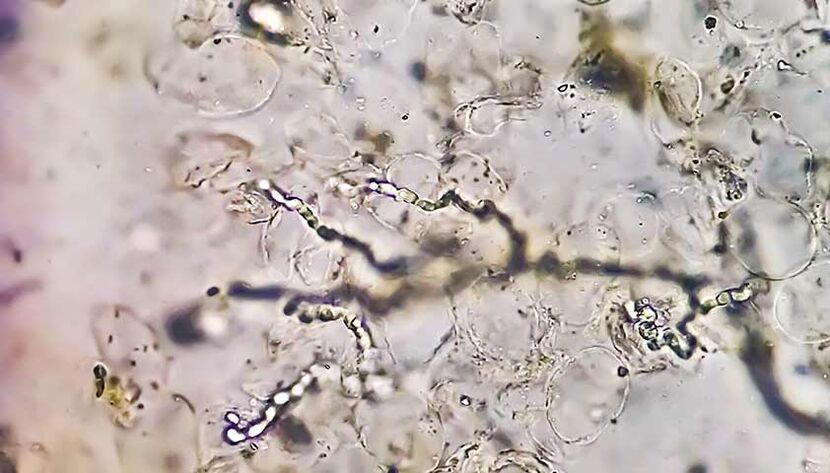 Fungi under the microscope – the culprit of the development of mycosis of the feet