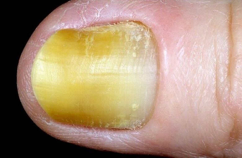 onycholysis of the nails